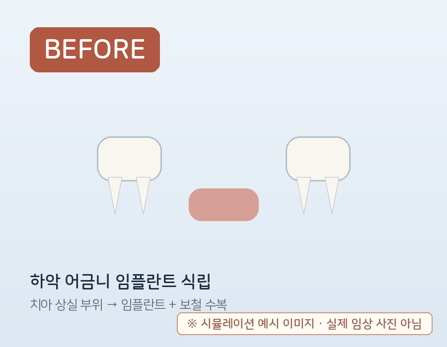 하악 어금니 임플란트 식립 (시뮬레이션 예시) 치료 전