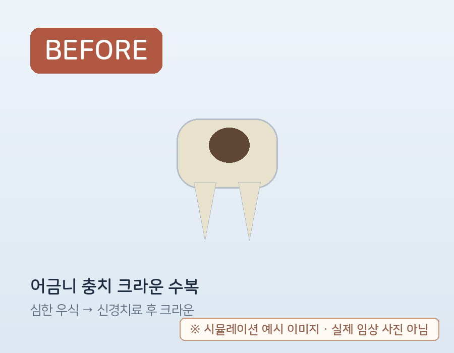 어금니 충치 신경치료 후 크라운 수복 (시뮬레이션 예시) 치료 전