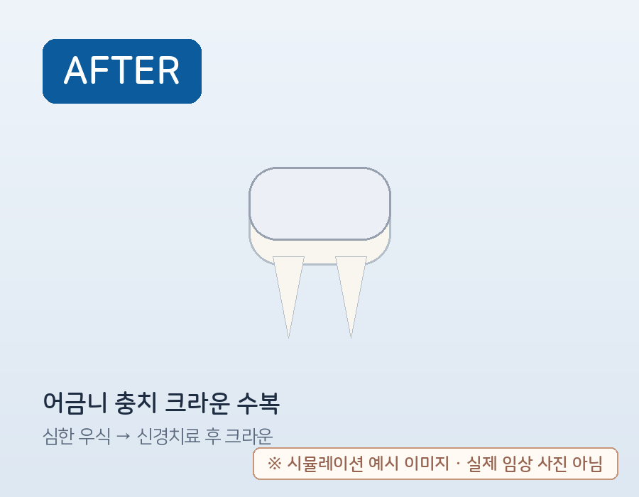 어금니 충치 신경치료 후 크라운 수복 (시뮬레이션 예시) 치료 후