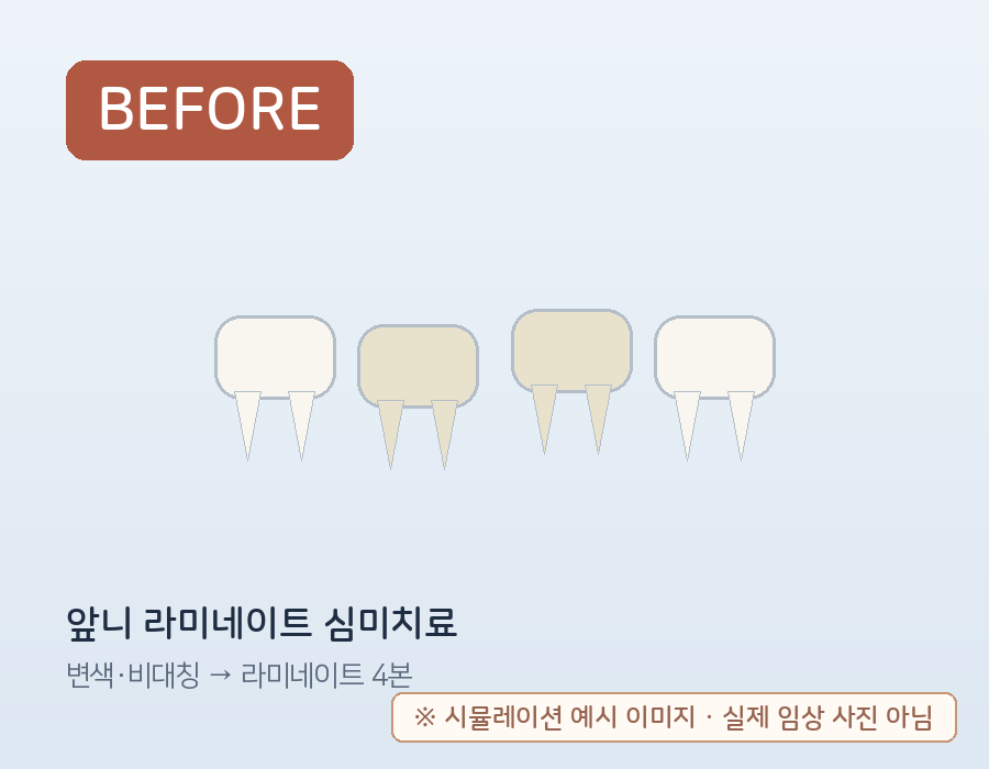 앞니 라미네이트 심미치료 (시뮬레이션 예시) 치료 전