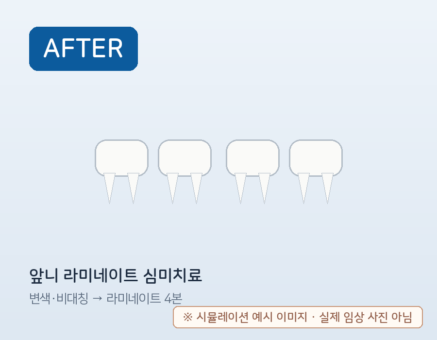 앞니 라미네이트 심미치료 (시뮬레이션 예시) 치료 후