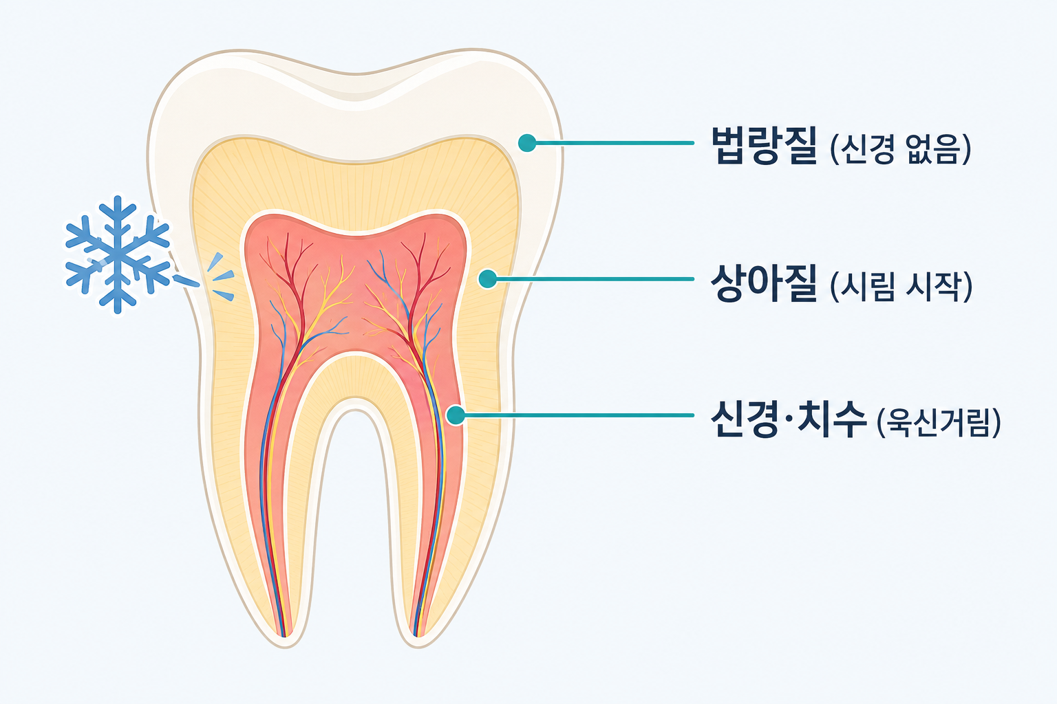 치아 단면 구조 - 법랑질, 상아질, 신경 순서와 통증이 시작되는 단계를 보여주는 그림.png