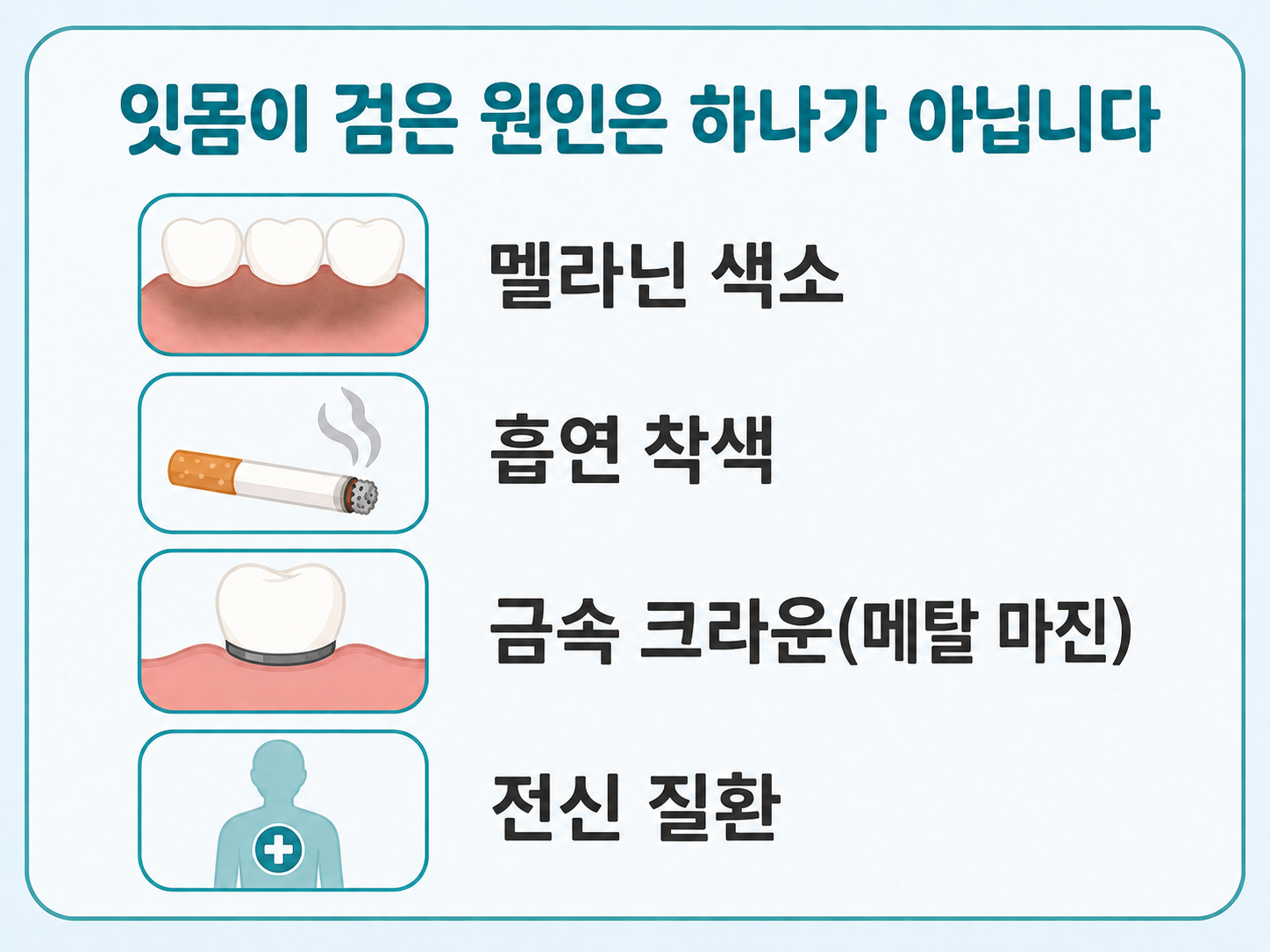 잇몸이 검어지는 네 가지 원인(멜라닌 색소, 흡연, 금속 크라운, 전신 질환)을 정리한 그림.png