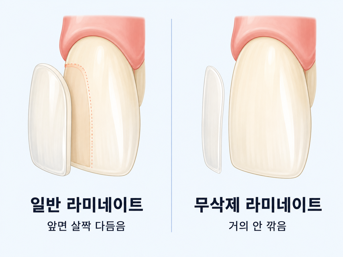 일반 라미네이트는 앞면을 살짝 다듬고 무삭제 라미네이트는 거의 깎지 않고 얇은 세라믹을 덧붙이는 차이 그림.png