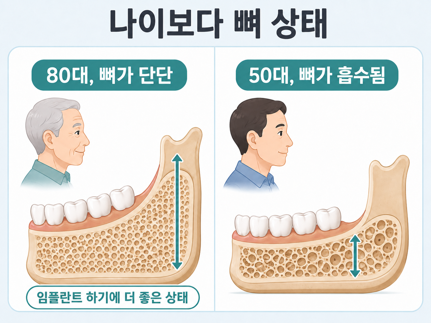 임플란트 가능 여부는 나이가 아니라 뼈 상태로 결정된다는 것을 80대와 50대 뼈 비교로 보여주는 그림.png