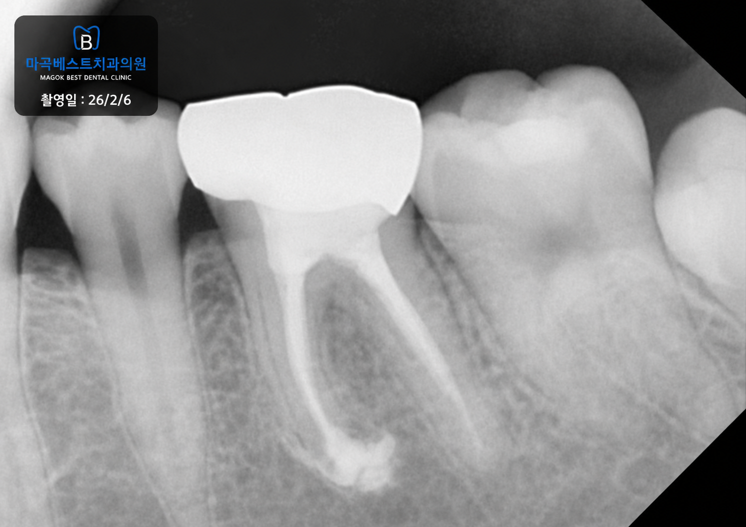 타 병원에서 발치를 권유받은 좌측 하악 제1대구치, 재근관치료 후 약 21개월 경과 치료 후