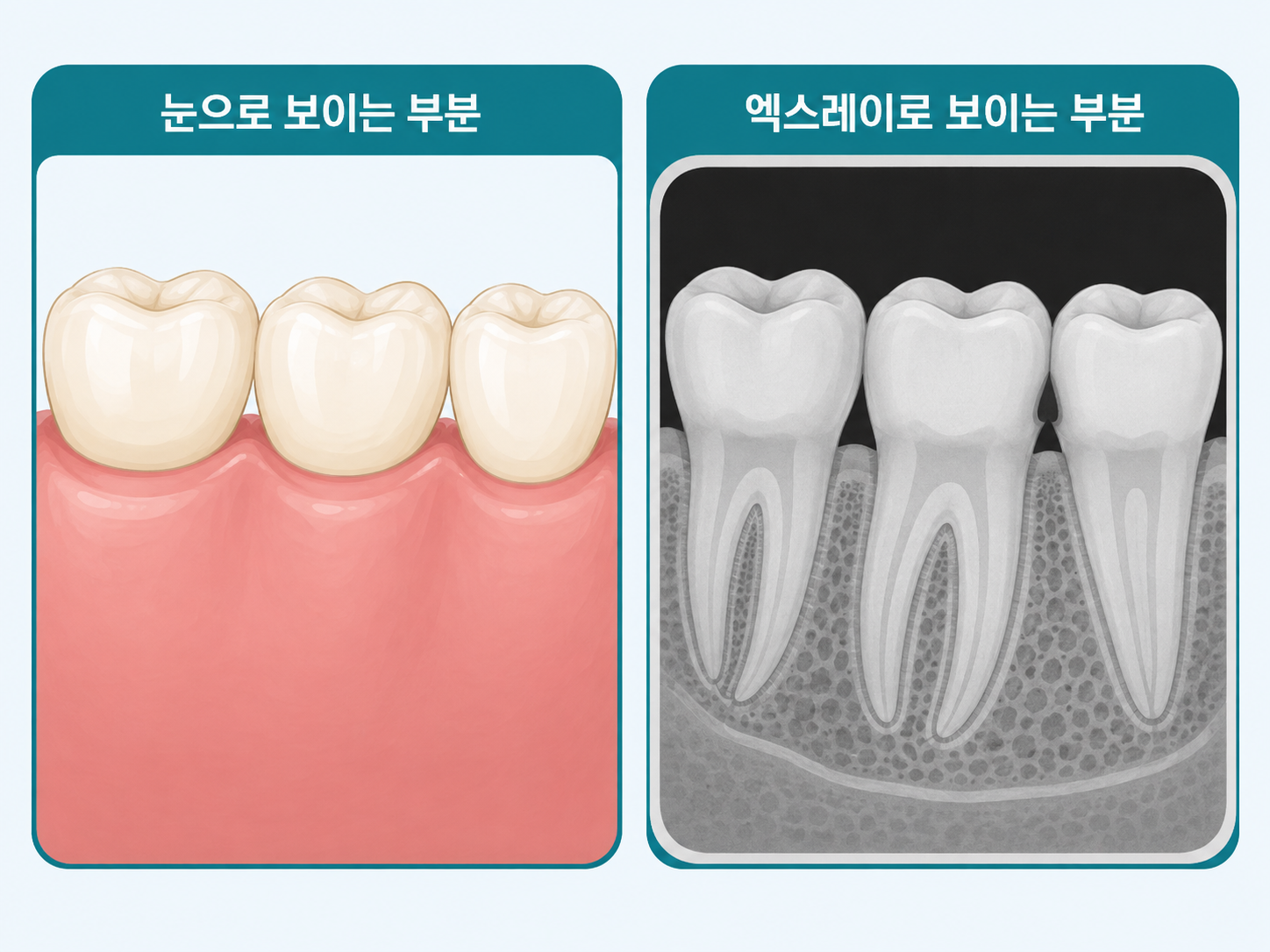 눈으로 보이는 치아 부분과 엑스레이로만 보이는 뿌리·뼈·숨은 충치를 비교한 그림.png