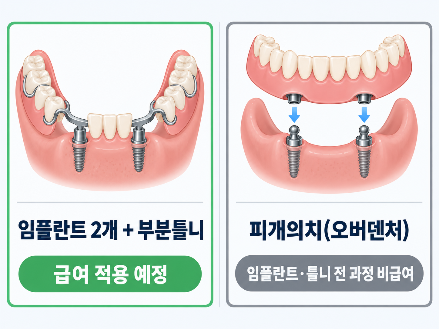 임플란트 2개, 부분틀니는 급여적용, 피개의치(오버덴처) 과정은 비급여임을 설명한 표.png
