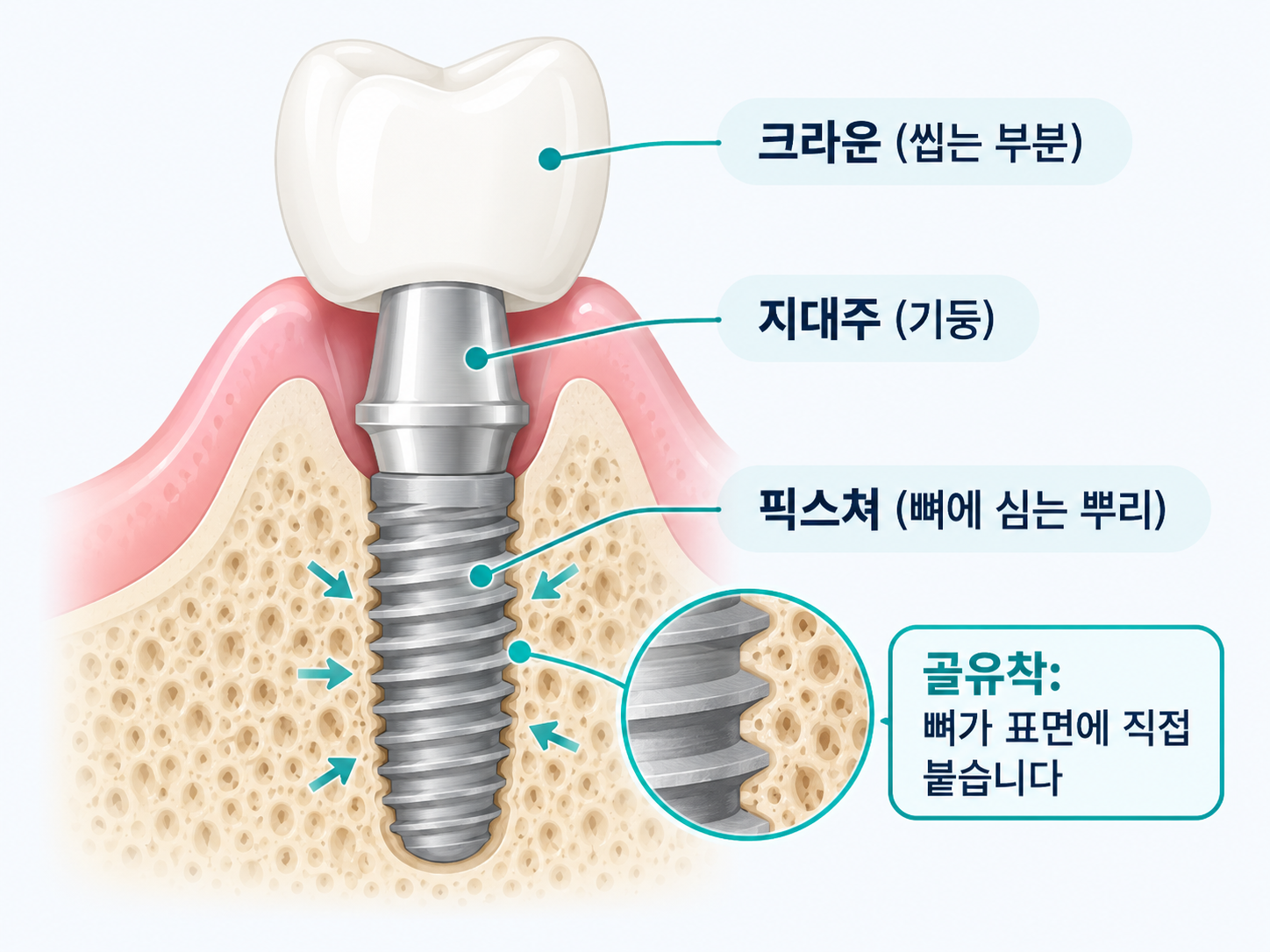 임플란트 구조와 골유착 원리 - 크라운, 지대주, 픽스쳐와 픽스쳐 표면에 뼈가 붙는 모습.png