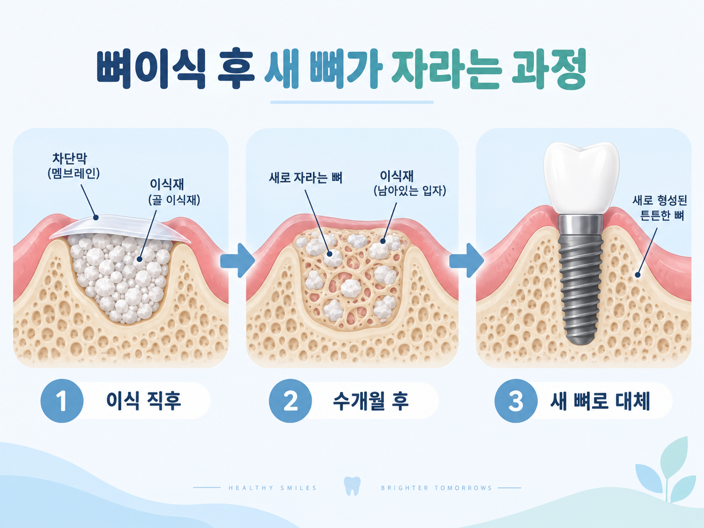 임플란트 뼈이식 후 새 뼈 형성 과정.png