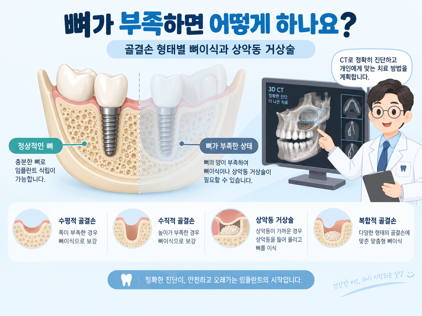 마곡 치과 임플란트 골결손 뼈이식 상악동 거상술.png