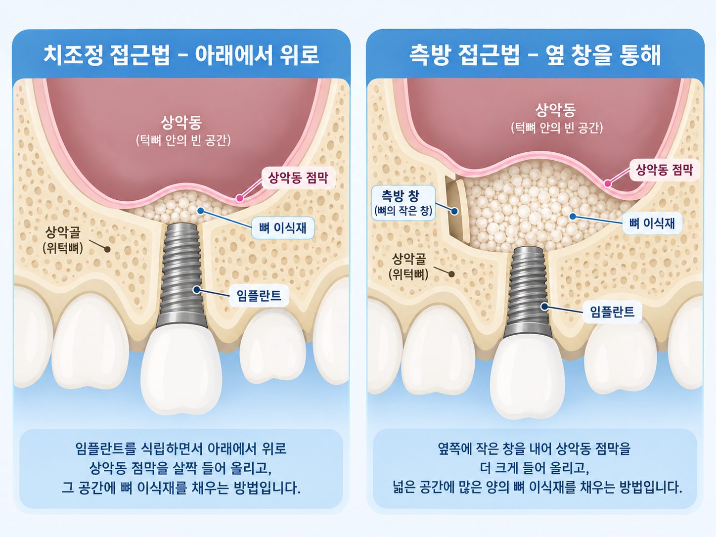강서구 치과 상악동 거상술 치조정 측방 접근법.png