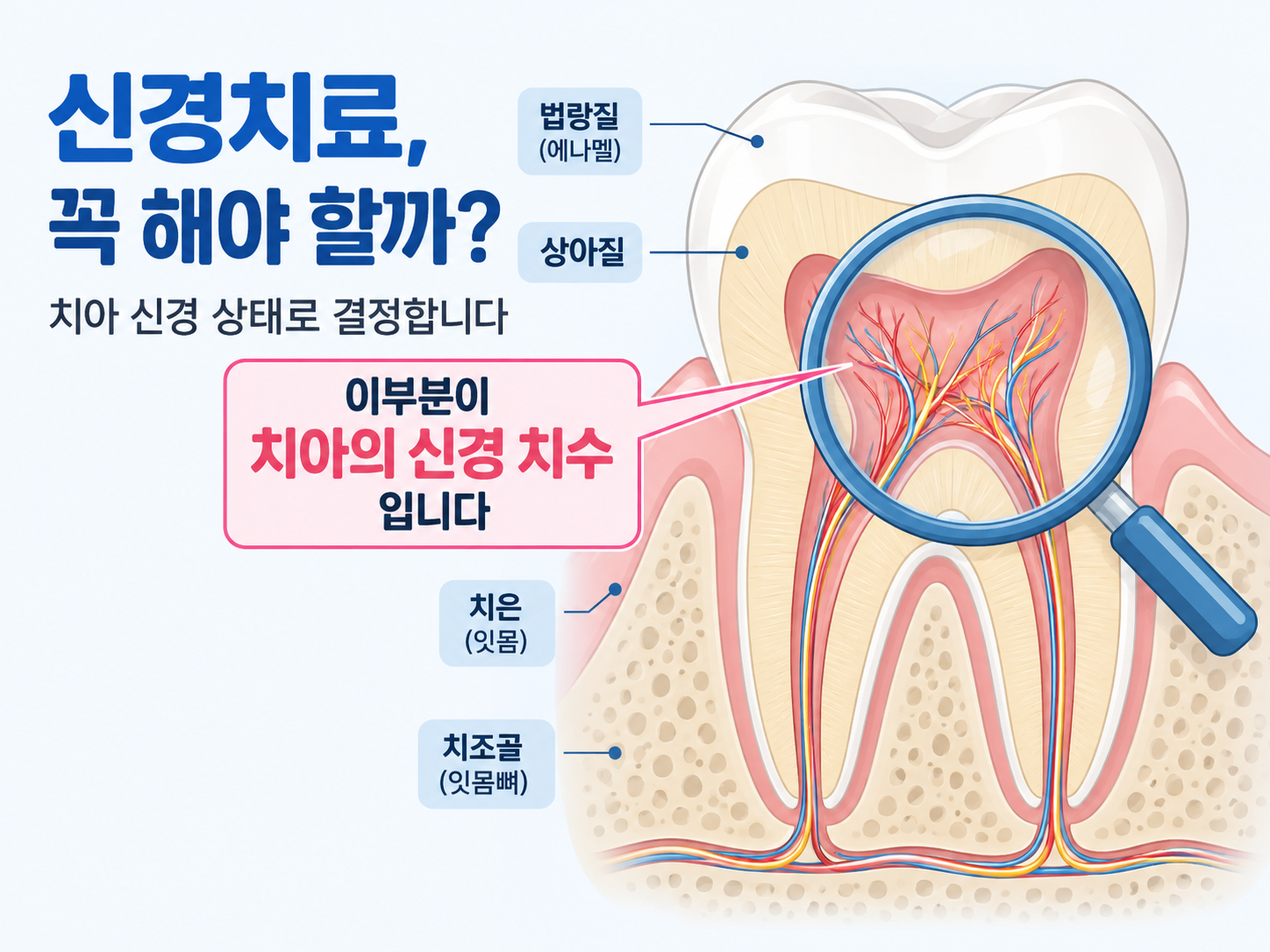 마곡 치과 신경치료 근관치료 치수 상태.png