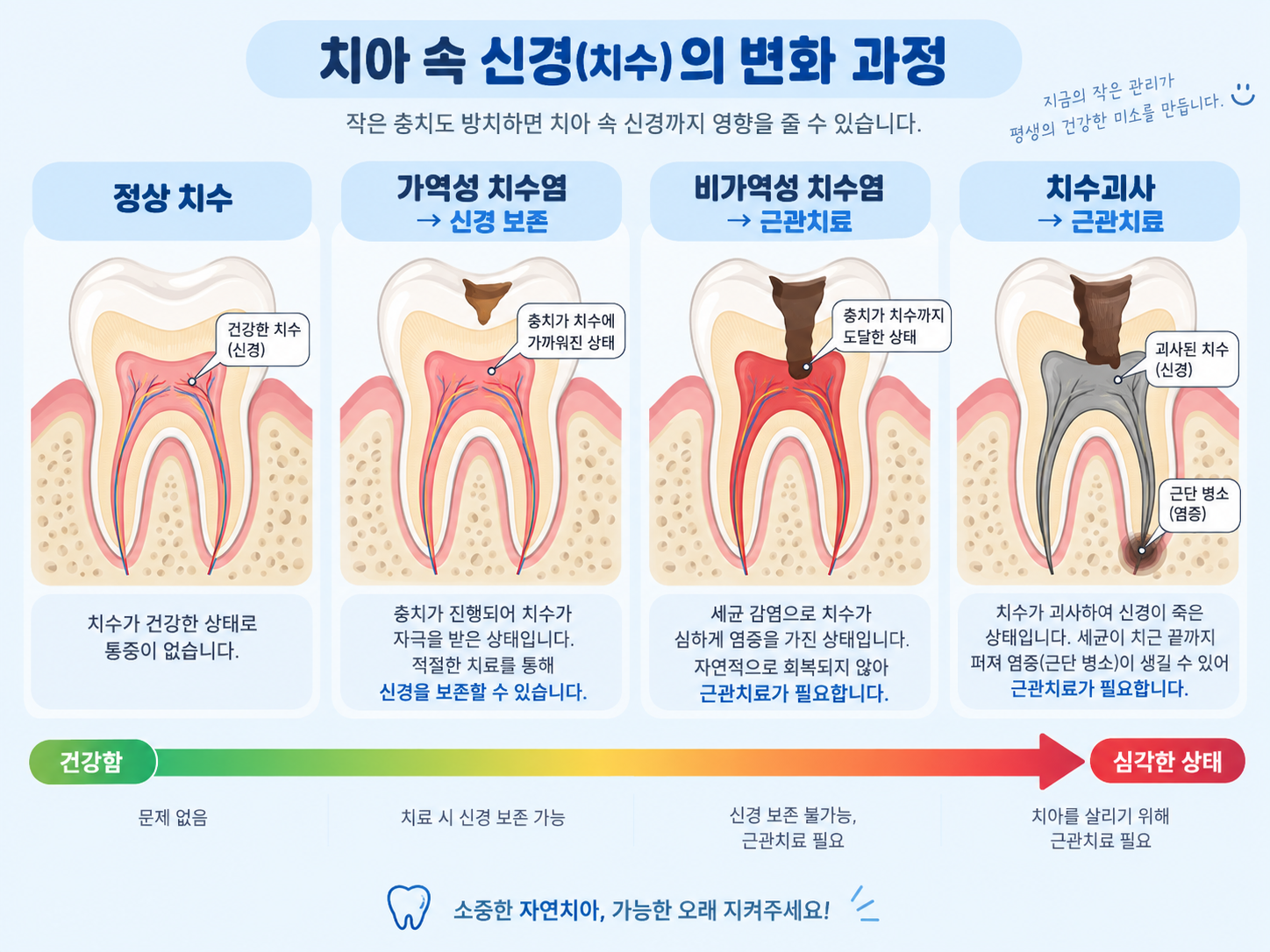강서구 치과 치수염 단계별 신경치료 필요한 경우.png