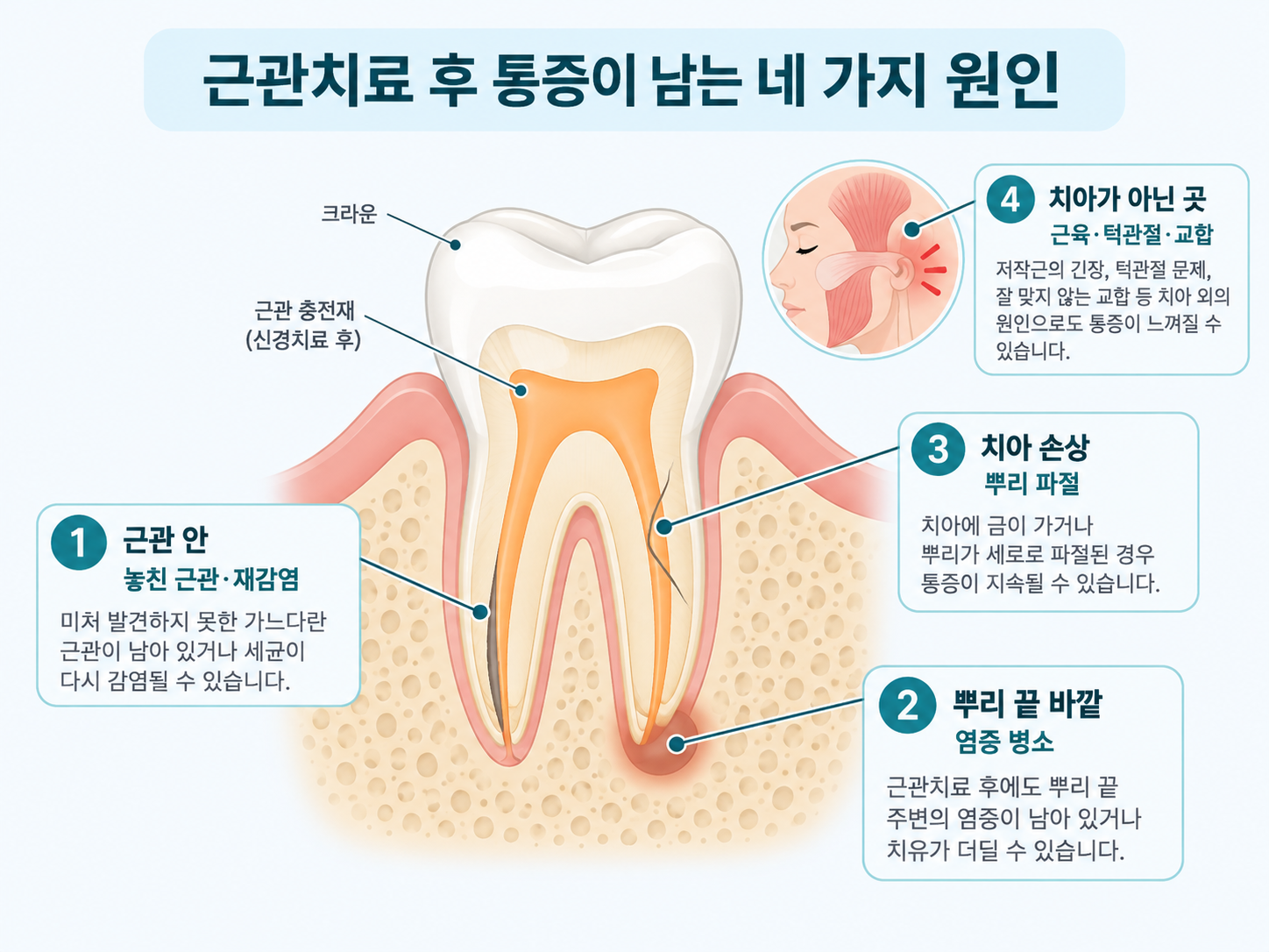 근관치료 후 통증이 계속되는 네 가지 원인 위치를 표시한 치아 단면 그림 - 근관 안, 뿌리 끝 바깥, 뿌리 파절, 치아 밖 원인.png
