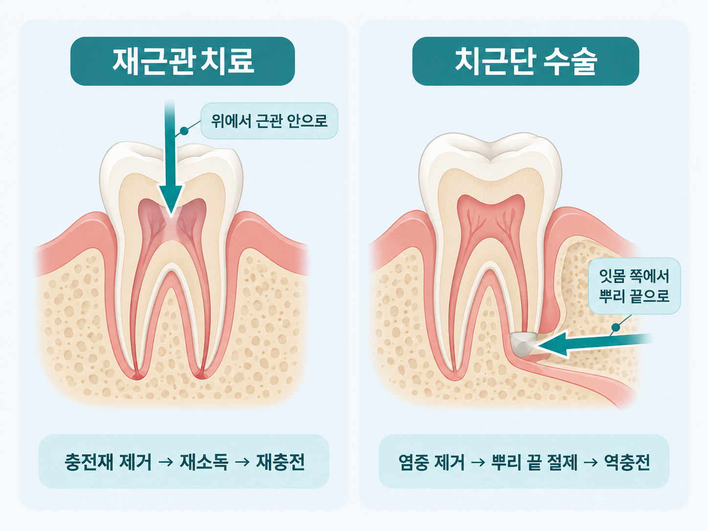 재근관치료와 치근단절제술의 접근 방향 비교 - 치아 위쪽에서 근관으로 들어가는 방법과 잇몸 쪽에서 뿌리 끝으로 접근하는 방법.png