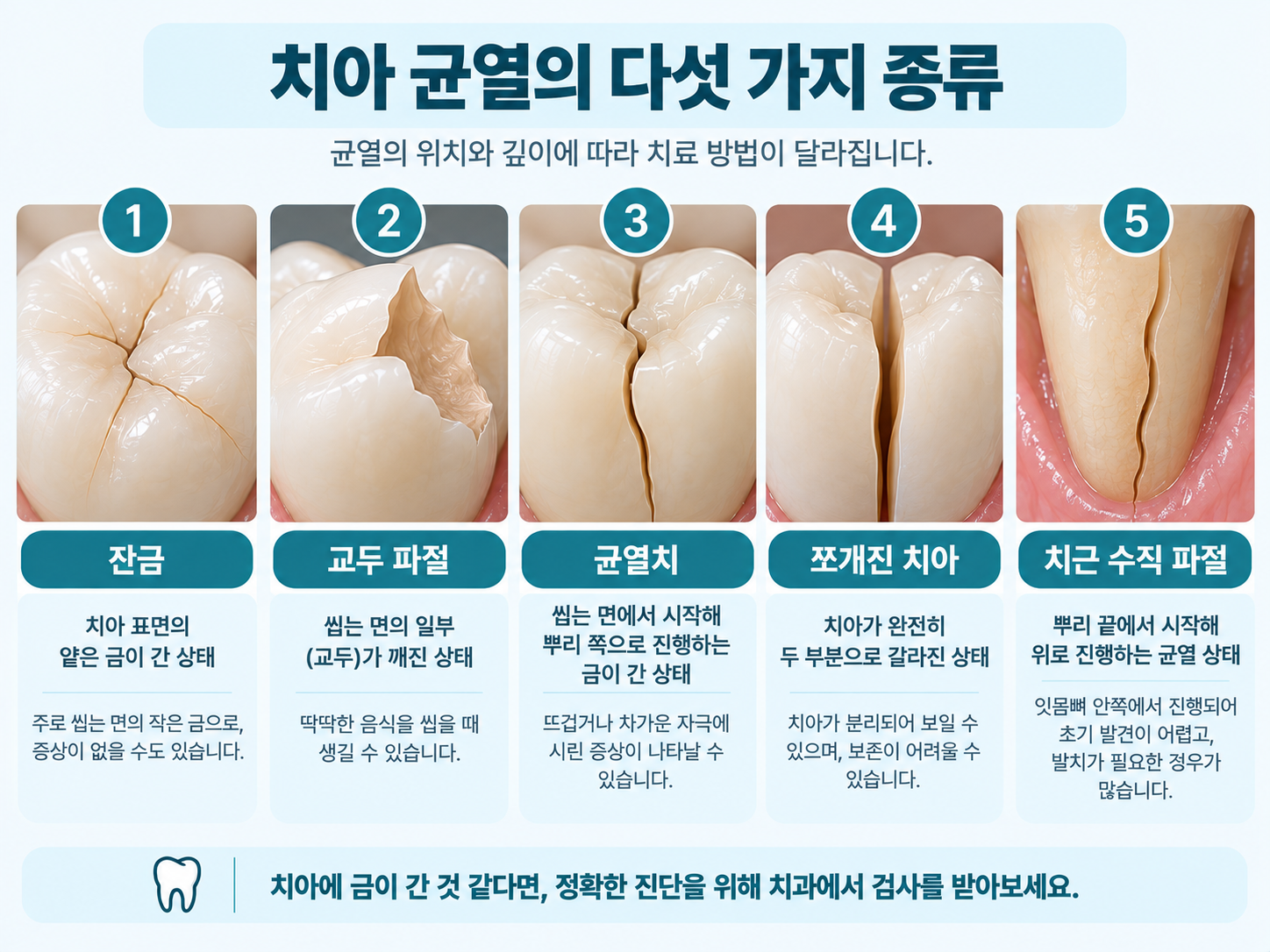 치아 균열의 다섯 가지 종류를 비교한 그림 - 잔금, 교두 파절, 균열치, 쪼개진 치아, 치근 수직 파절.png