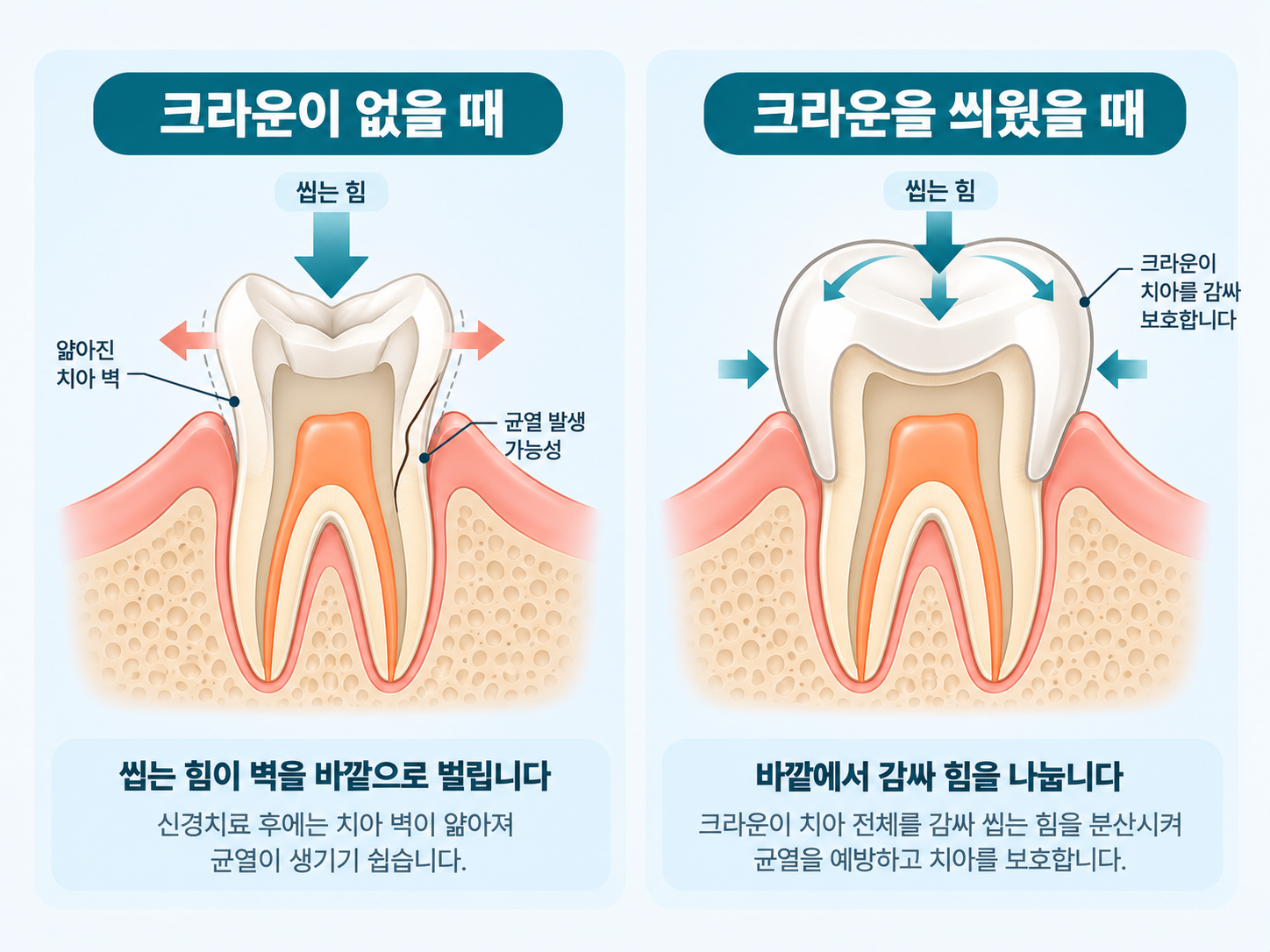 근관치료한 치아에 크라운이 없을 때와 있을 때 씹는 힘이 전달되는 방향을 비교한 단면 그림.png