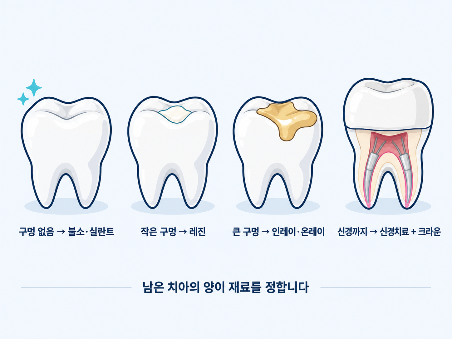 남은 치아의 양에 따라 충치 재료를 정한다는 일러스트.png