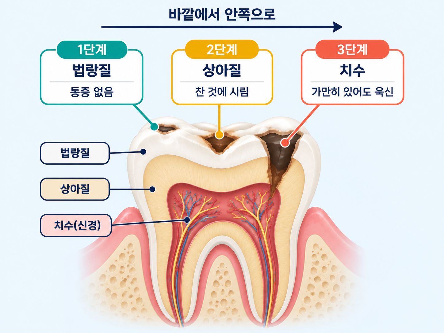 충치 진행 단계 법랑질 상아질 치수 3단계와 증상.png